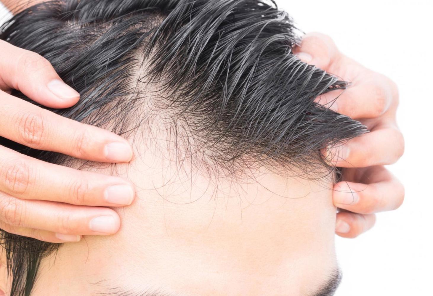 Why Are You Losing Hair? Know the Four Common Causes