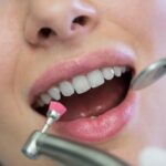 Composite Bonding